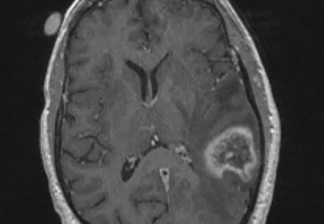 MRI of a patient with brain metastases