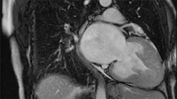 Imaging of non-obstructive hypertrophic cardiomyopathy