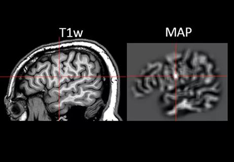 18-NEU-507-Wang-Morphometric-MRI-650&#215;450