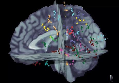 21-NEU-2183759_brain-mapping-in-epilepsy_650x450