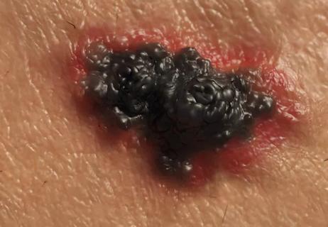 melanoma_650x450