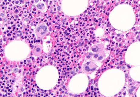 Megakaryocytic hyperplasia and clustering reminiscent of myeloproliferative neoplasms can be seen in the bone marrow trephines of POEMS patients (H&E, 400x).