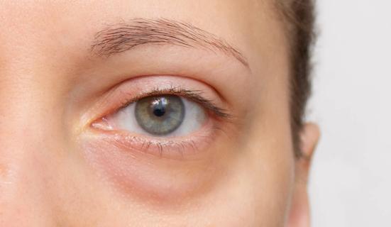 Person with puffy under eye bag