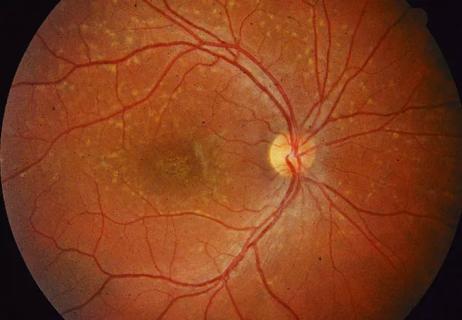20-EYE-1875134-CQD-Gene-Therapy