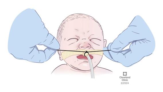 Illustration of neonate and endotracheal tube placement