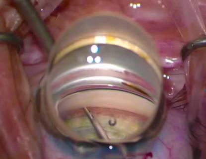 Microinvasive glaucoma surgery