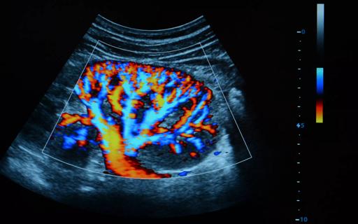 Ultrasound of kidney