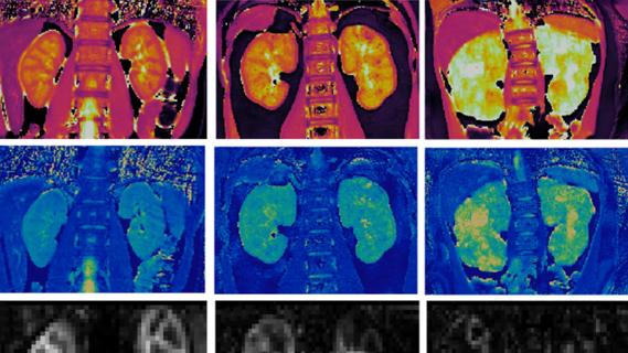 MRI images of pediatric kidney disease