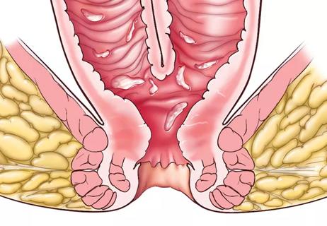 18-DDI-161-Ileal-Pouch-Feat