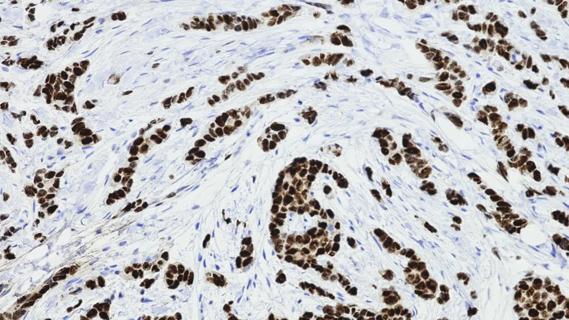 Lobular breast cancer cells