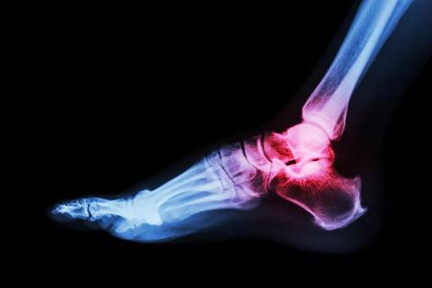 Ankle x-ray