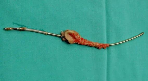 extracted cardiac device lead covered with vegetations