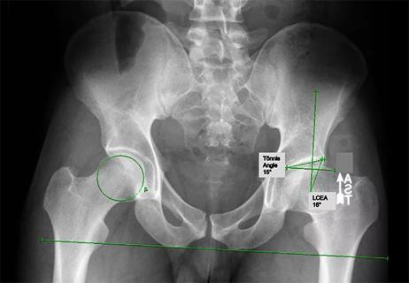 Perthes-Deformity-Hip-650&#215;450
