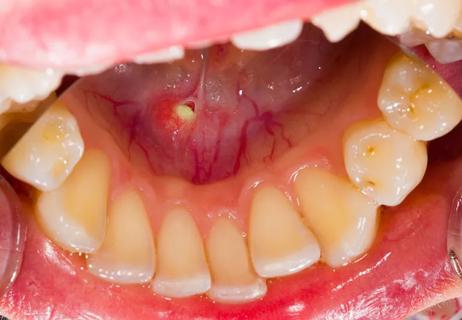 salivary stone in mouth