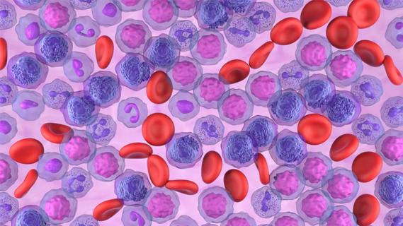 Acute myeloid leukemia