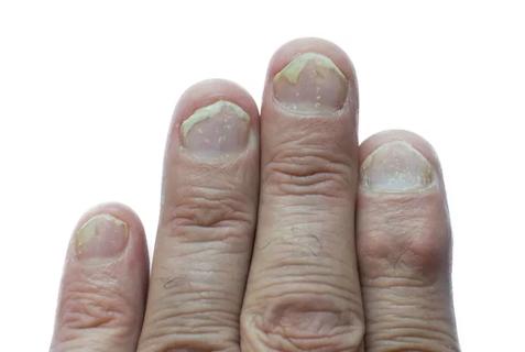 psoriasis of the fingernails and psoriatic arthritis on white background