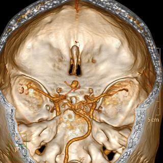 Center for Cerebrovascular Care: Complex Cerebrovascular, Neurovascular & Skull Base Referral Program