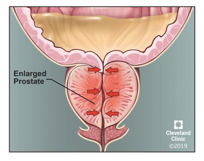 BPH illustration