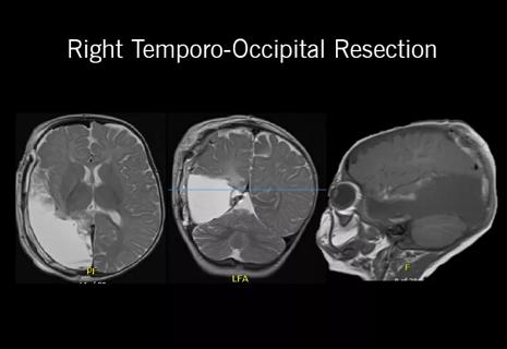 resective surgery for epilepsy