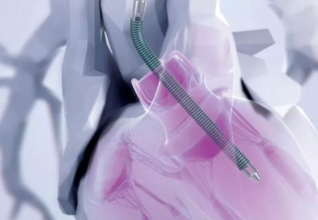 pointy medical device entering chambers of the heart through a major vessel