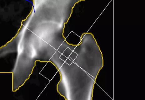 ual energy x-ray absorptiometry scan showing periosteal elevation, an early diagnostic sign of atypical femoral fractures