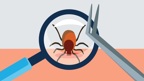 Magnifying glass over a tick embedded in skin, with tweezers ready to remove it