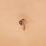 Navel-Melanoma