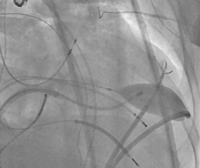 RF ablation is delivered endocardially opposite the epicardial target, with the inflated balloon remaining in position. 