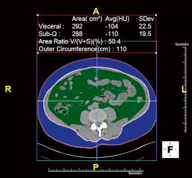 Noncontrast CT scans of kidney stones