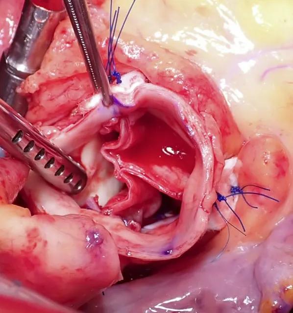 operative photo of a heart valve during surgery