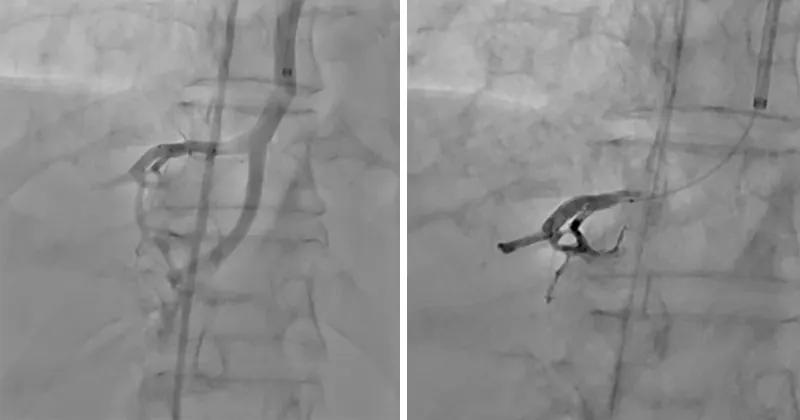 side-by-side medical scans showing curved blood vessels