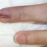 Nail-Melanoma
