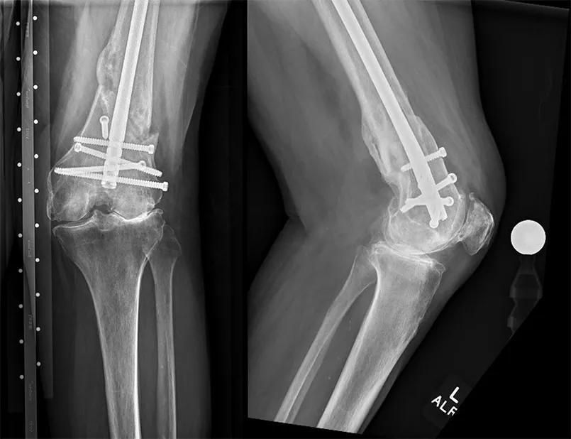 X-ray of healed fracture