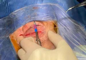 Closing the incision