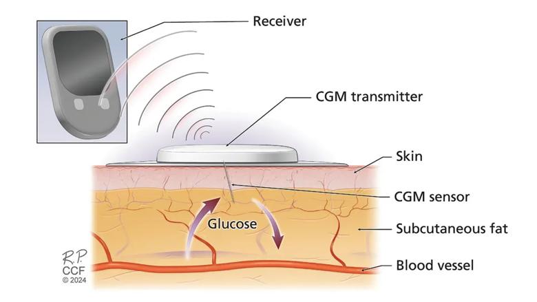 Medical illustration of CGM