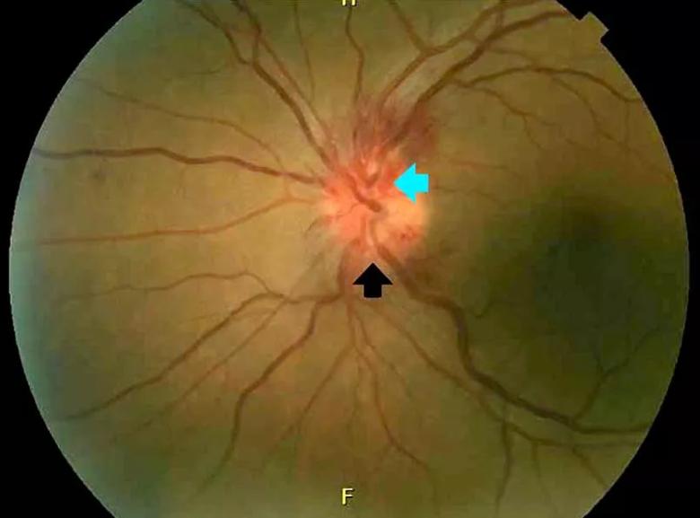 A dilated fundus photograph of the left eye shows optic disc edema (black arrow) with optic disc hemorrhages (blue arrow).