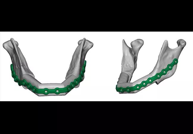 1-year-old male from Kuwait who presented with a large multilocular, expansile lesion in the mandible