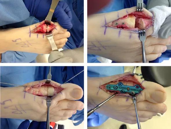 Intraoperative images showing the hemiarthroplasty implant in place but loose (top left) and then removed (top right) and replaced with an intercalary bone allograft (bottom left) followed by placement of a dorsal plate and screws (bottom right). BMP-2 was placed on both sides of the graft into the intramedullary canals of the phalanx and metatarsal.