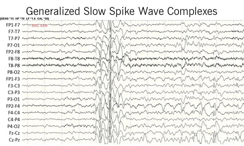 EEG recording showing spike wave complexes