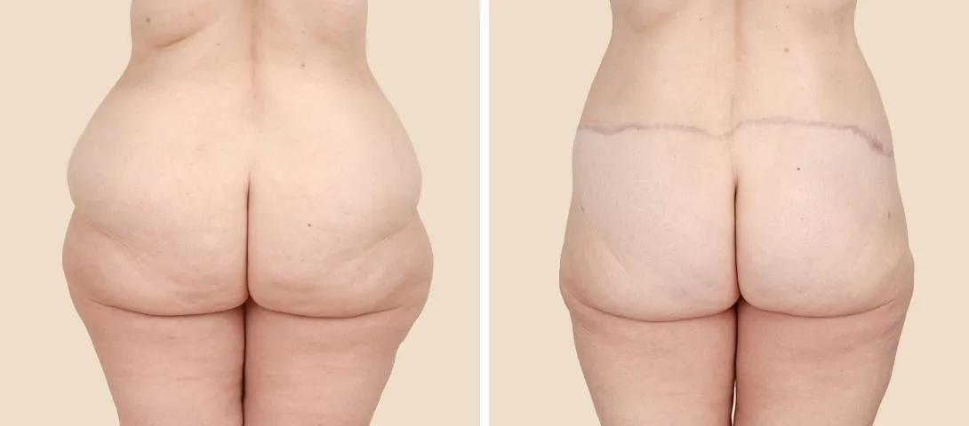 Back View - Before and After