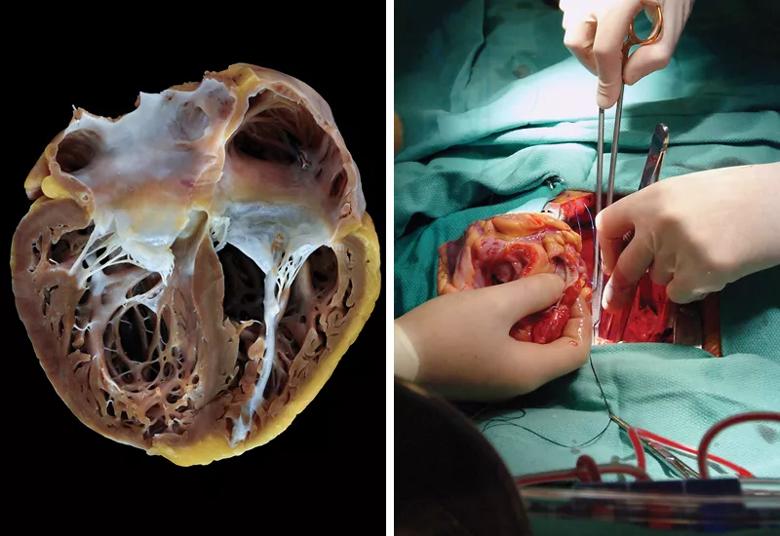 photos of an explanted diseased heart and a heart transplant in progress