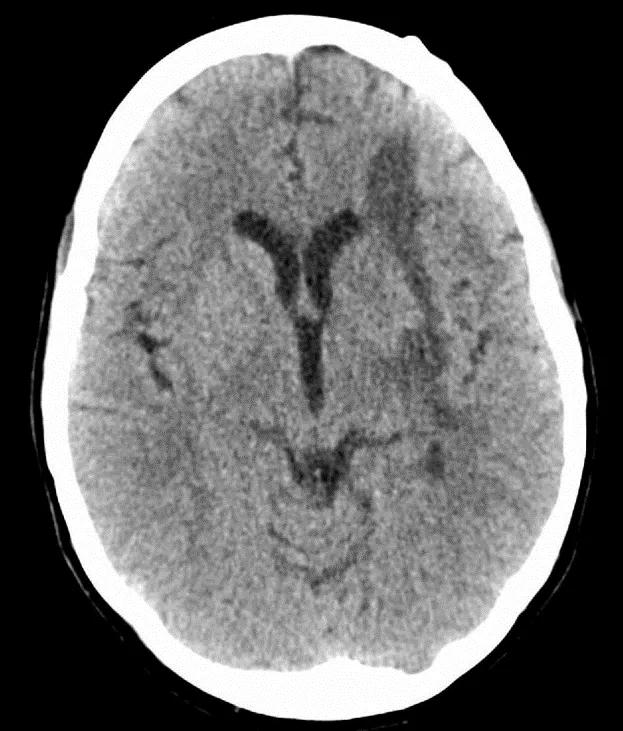 postoperative axial head CT showing resolution of intracerebral hemorrhage
