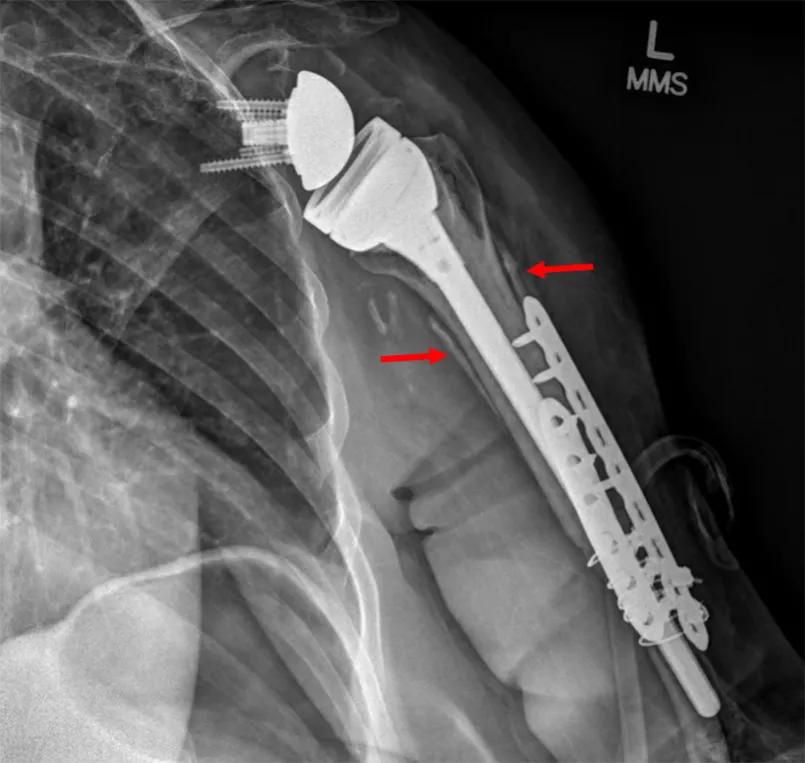 Implant