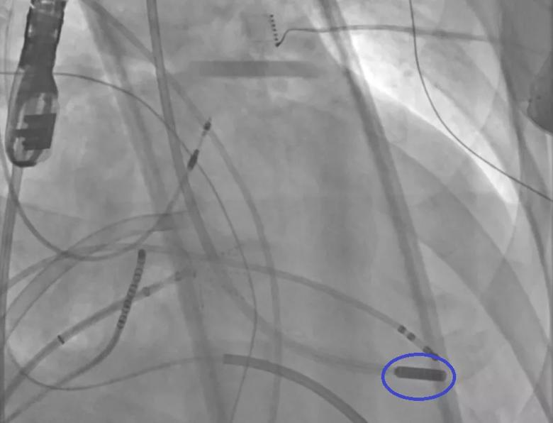 Endocardial ultra-low temperature cryoablation (ULTC) via the aortic valve. 