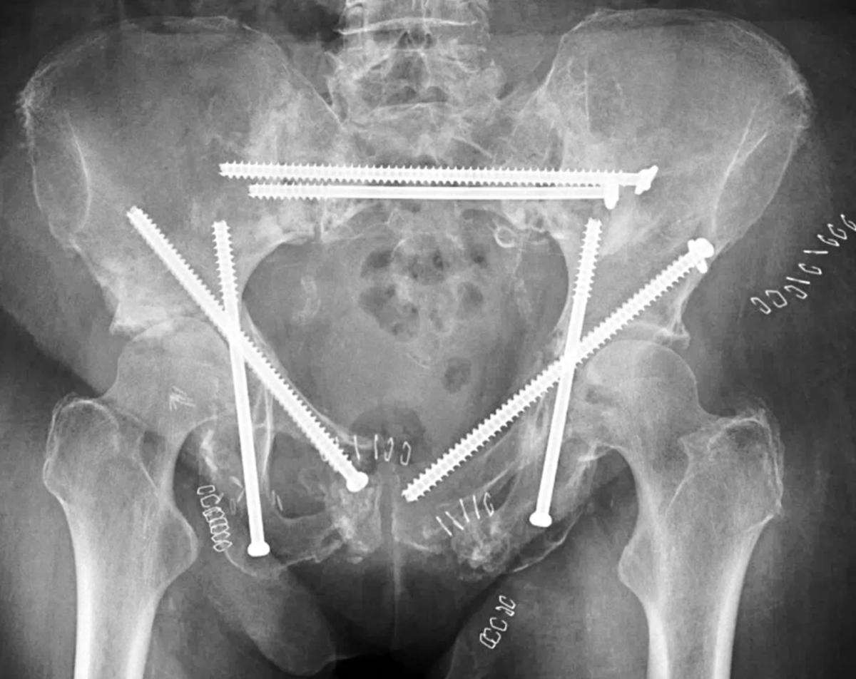 X-ray image of pelvic ring fixation