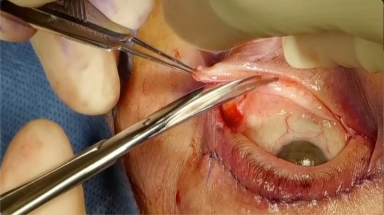 Conjunctival incision just beneath the tarsus.