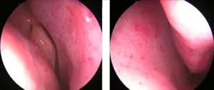 Endoscopic nasal HHT