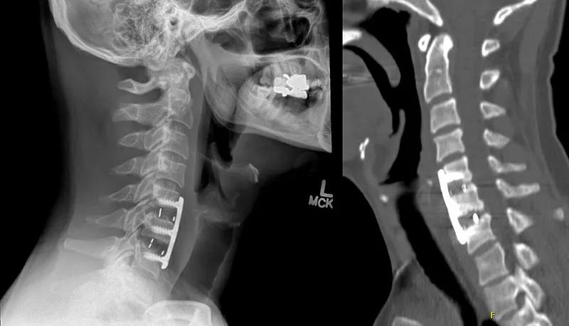 two x-rays of a human neck 