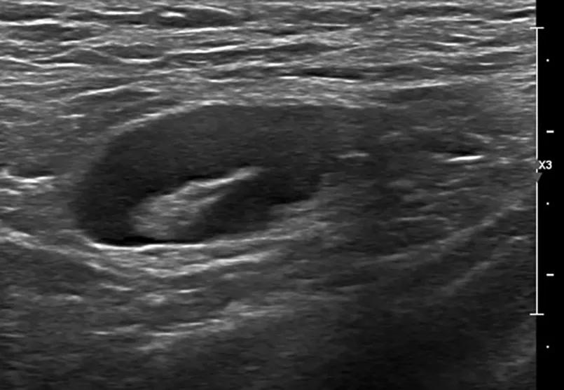 abnormal node