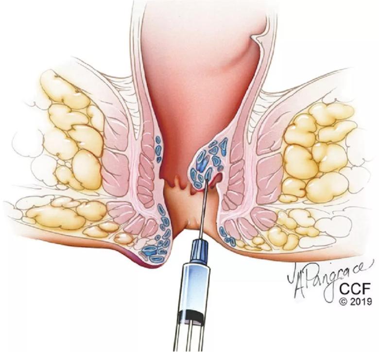 Hemorrhoids The Definitive Guide to Medical and Surgical Treatment